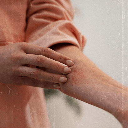 Žvynelinė – lėtinė odos liga, kurią gali iššaukti orų pokyčiai: kaip ją suvaldyti?